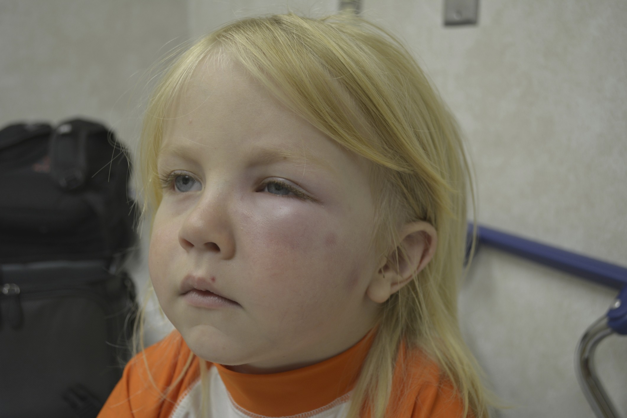 Глаза после прививки. Анафилактический ШОК ангионевротический отек Квинке. Анафилактический ШОК У детей. Кожные проявления анафилаксии.
